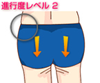メディカルセルの施術によるセルライト及びボディラインの変化